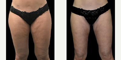 Liposuction before and after photo