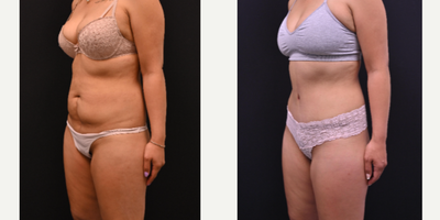Mommy Makeover before and after photo