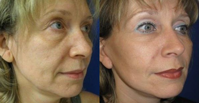 Neck Lift before and after photo