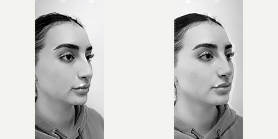 Nonsurgical Nose Job before and after photo