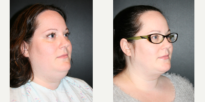 Chin Liposuction before and after photo