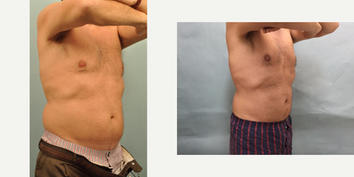 CoolSculpting before and after photo