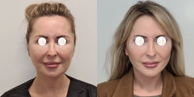 Facelift before and after photo