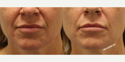 Juvederm before and after photo