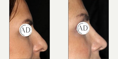 Rhinoplasty before and after photo