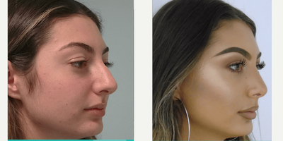 Rhinoplasty before and after photo