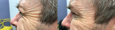 Botox before and after photo