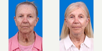 Brow Lift before and after photo