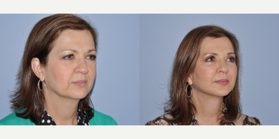 Facelift before and after photo