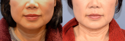 Jaw Reduction before and after photo