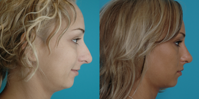 Rhinoplasty before and after photo