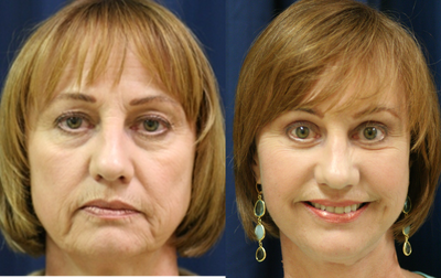 Eyelid Surgery before and after photo