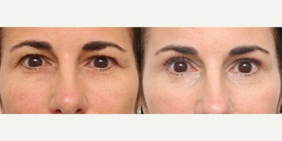 Eyelid Surgery before and after photo