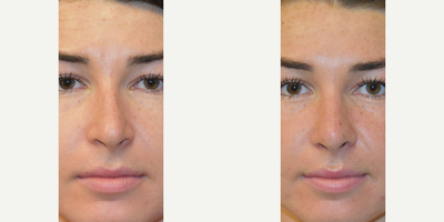 Rhinoplasty before and after photo