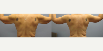 Arm Lift before and after photo