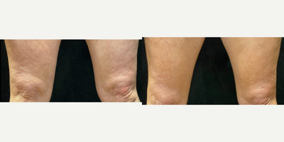 BodyTite before and after photo