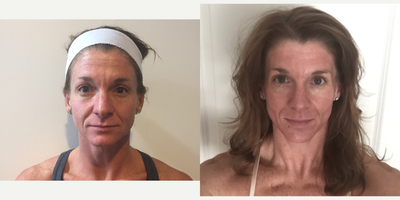 CO2 Laser before and after photo