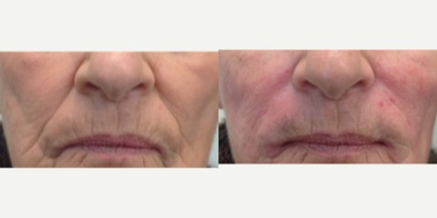 Radiesse before and after photo