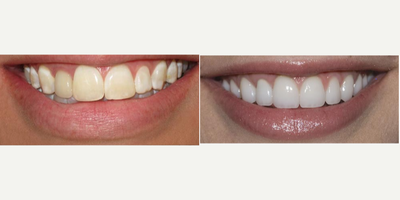 Smile Makeover before and after photo