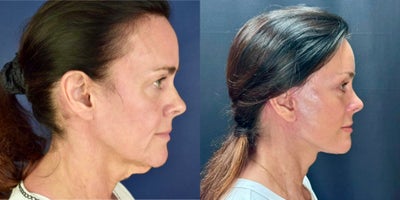 Brow Lift before and after photo