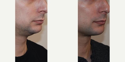 Chin Liposuction before and after photo