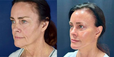 Deep Plane Facelift before and after photo