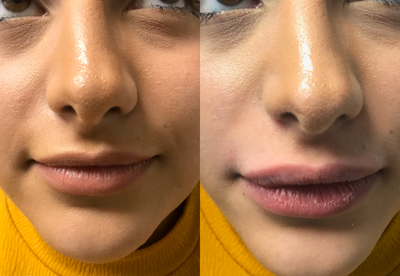 Dermal Fillers before and after photo