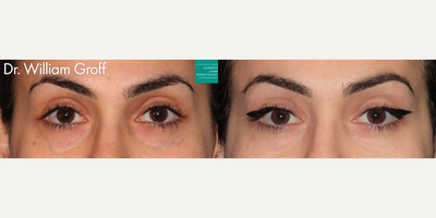Sclerotherapy before and after photo