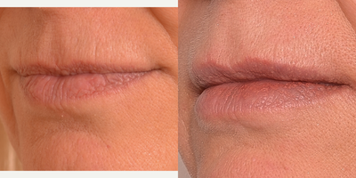 Volbella before and after photo