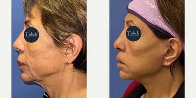 before and after image