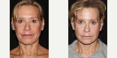 Facelift before and after photo