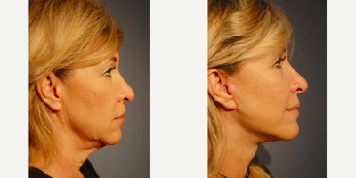 Facelift before and after photo