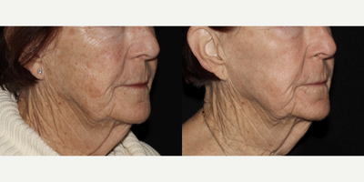 Fraxel Laser before and after photo