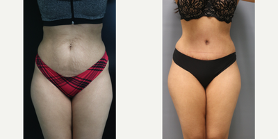 Panniculectomy before and after photo