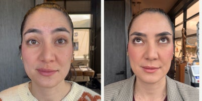 Botox before and after photo