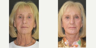 Chin Implant before and after photo