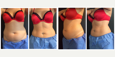 CoolSculpting before and after photo