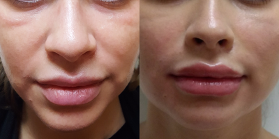 Dermal Fillers before and after photo