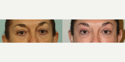 Eyelid Surgery before and after photo
