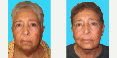 Facelift before and after photo