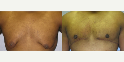 Gynecomastia Surgery before and after photo