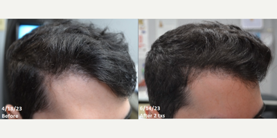 Hair Loss Treatment before and after photo