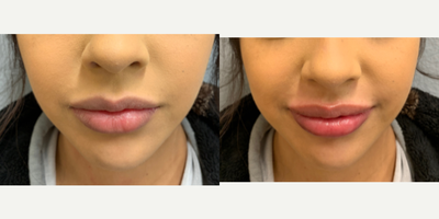 Juvederm before and after photo