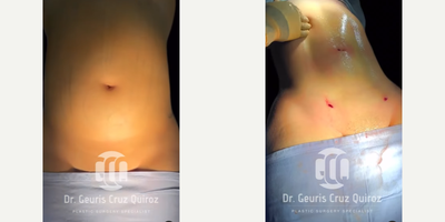 Liposuction before and after photo
