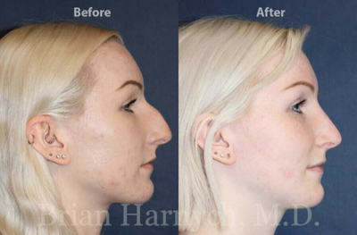 Rhinoplasty before and after photo