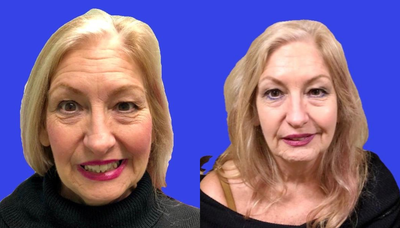 Botox before and after photo