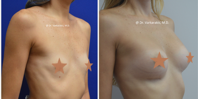 Breast Augmentation before and after photo