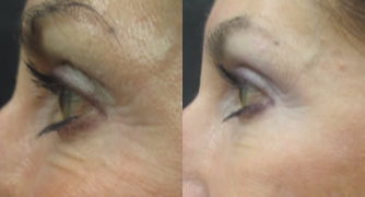 Dysport before and after photo