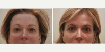 Eyelid Surgery before and after photo