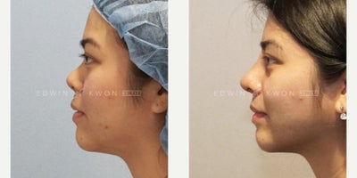 Rhinoplasty before and after photo